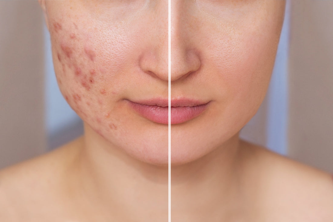 How Red and Blue Light Therapy Work for Acne